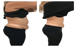 Aqualyx_Injection_Treatment_before_after_in_Islamabad