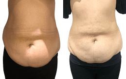 Aqualyx_Injection_Treatment_result_in_Islamabad