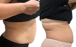 Aqualyx_injectable_treatment_in_Islamabad_Pakistan