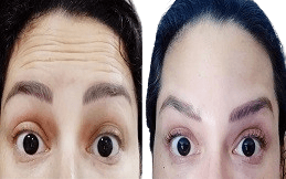 Baby Botox before after in Islamabad