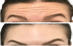 Baby Botox in Islamabad