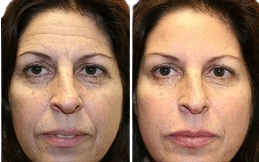 Baby Botox in Islamabad,Pakistan