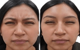 Baby Botox injection