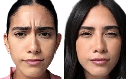 Baby_Botox_result__in_Islamabad