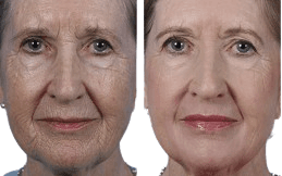 Bio-Revitalization Treatment in Islamabad