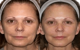 Bio-Revitalization Treatment in Islamabad,Pakistan