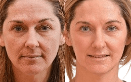 Bio-Revitalization Treatment