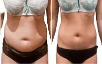 Body Contouring before after in Islamabad