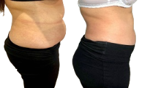 Body Contouring cost in Islamabad