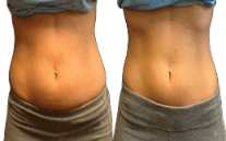 Body Contouring in Islamabad,Pakistan