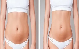 Body Contouring result in Islamabad