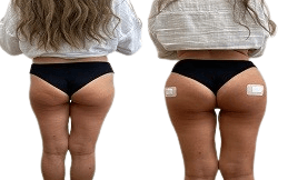 Body Fillers before after in Islamabad