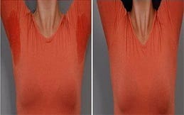 Botox for Sweaty Glands before after