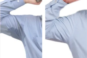 Botox for Sweaty Glands before after result