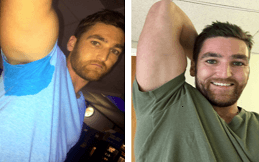 Botox for Sweaty Glands cost in Islamabad