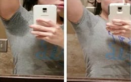 Botox for Sweaty Glands in Islamabad