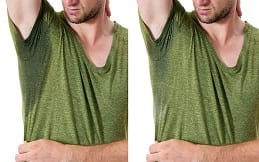 Botox for Sweaty Glands