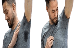 Excessive Sweating Hyperhidrosis treatment cost in Islamabad