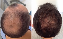 FUSS Hair Transplant in Islamabad