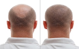 FUSS Hair Transplant before and after in Islamabad