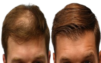 FUSS Hair Transplant