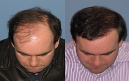 Hair Transplant in Lahore