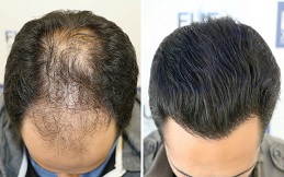 Hair Transplant surgery in Lahore
