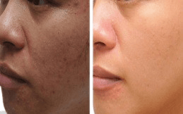 IV drip therapy cost in Islamabad