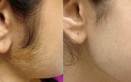 Laser Hair Bleaching cost in Islamabad