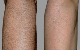 Laser Hair Bleaching cost in Islamabad