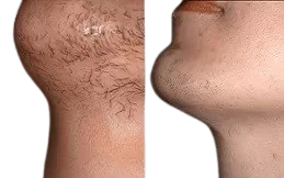 Laser Hair Bleaching in Islamabad