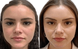 Nano Thread Lift in Islamabad