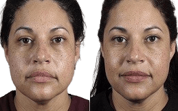 Nano Thread Lift result in Islamabad