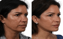 Nano Thread Lift treatment