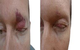 Port Wine Stains removal result in Islamabad