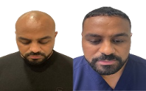 Robotic Hair Transplant Islamabad