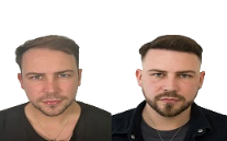 Robotic Hair Transplant cost in Islamabad