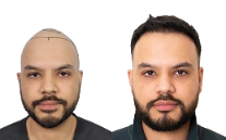 Robotic Hair Transplant