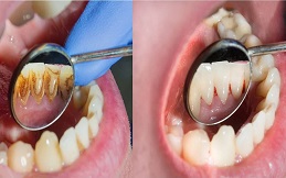 Routine Dental Check Ups and Cleaning in Islamabad