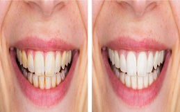 Routine dental check ups and cleaning before and after in Islamabad
