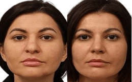 Silhouette Facelift cost in Islamabad