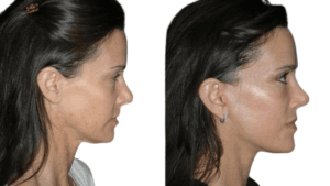 Silhouette Facelift in Islamaba,Pakistan