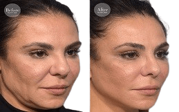 Silhouette Facelift in Islamabad