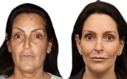 Silhouette Facelift result in Islamabad