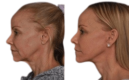 Silhouette_Facelift_before_after_in_Islamabad