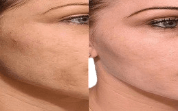 Skin Booster before after in Islamabad