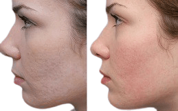 Skin Booster cost in Islamabad