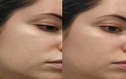 Skin Booster in Islamabad