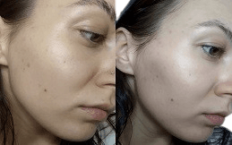 Skin Booster in Islamabad,Pakistan