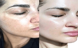 Skin Booster result in Islamabad
